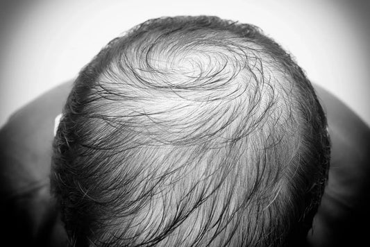 Hair Today, Gone Tomorrow Exploring the Onset of Hair Loss in Men