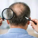 What Causes Crown Thinning? A Clear Answer 1 What Causes Crown Thinning? A Clear Answer